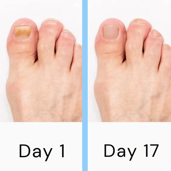 LED Nail Fungus Treatment Device with Dual Wavelength Light and Auto 7-Minute Sessions