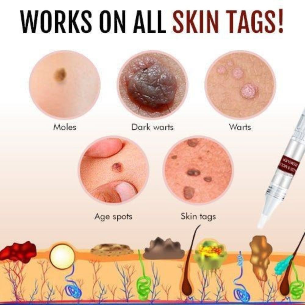 Skin Tag Remover Solution with Tea Tree Oil and Arborvitae Extract