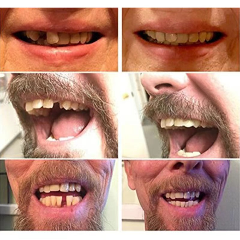 Temporary Cosmetic Teeth Veneer with Moldable Adhesive and Natural Tooth Shade