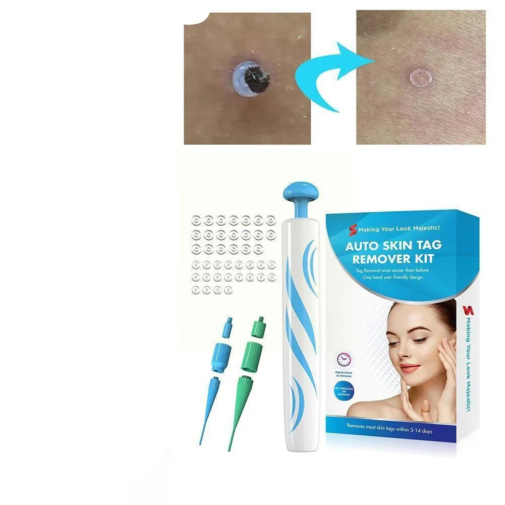 Skin Tag Removal Kit with Dual Spring Sizes and Blood Flow Restriction