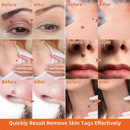 Skin Tag Removal Kit with Dual Spring Sizes and Blood Flow Restriction