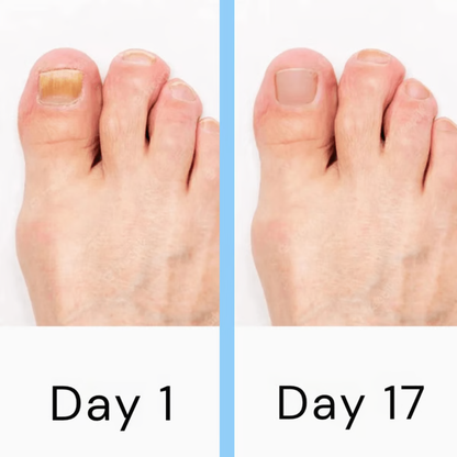 LED Nail Fungus Treatment Device with Dual Wavelength Light and Auto 7-Minute Sessions