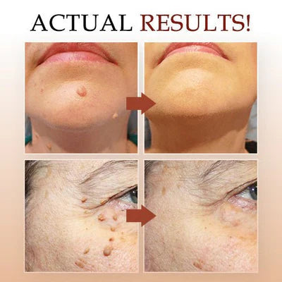 Skin Tag Remover Solution with Tea Tree Oil and Arborvitae Extract