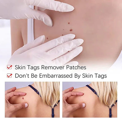 Skin Tag Remover Solution with Tea Tree Oil and Arborvitae Extract