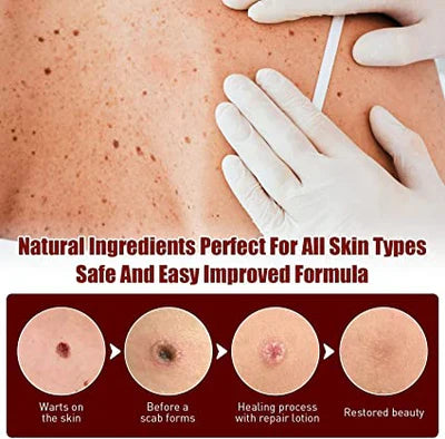 Skin Tag Remover Solution with Tea Tree Oil and Arborvitae Extract
